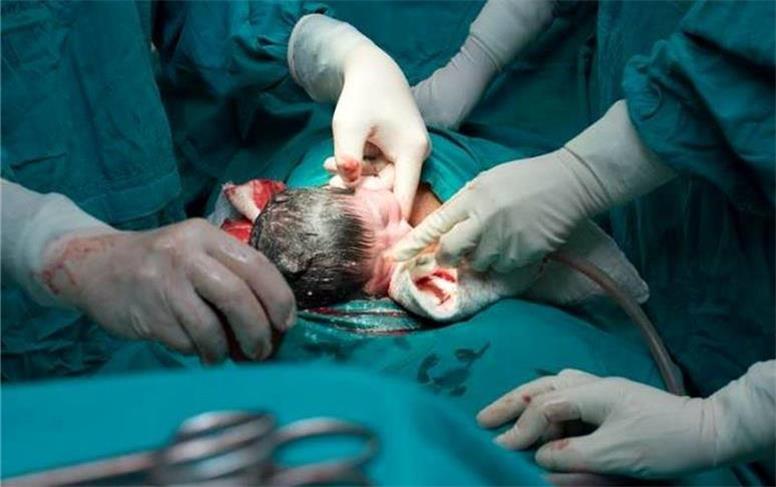 نصف شدن نوزاد توسط پرستاران در لحظه زایمان !